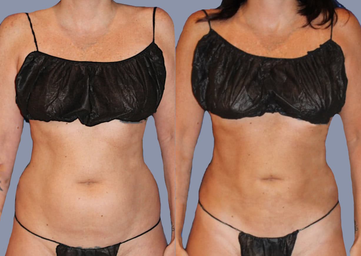 Abdominal / Flank Liposuction before and after, front view — a patient of Dr. Stein