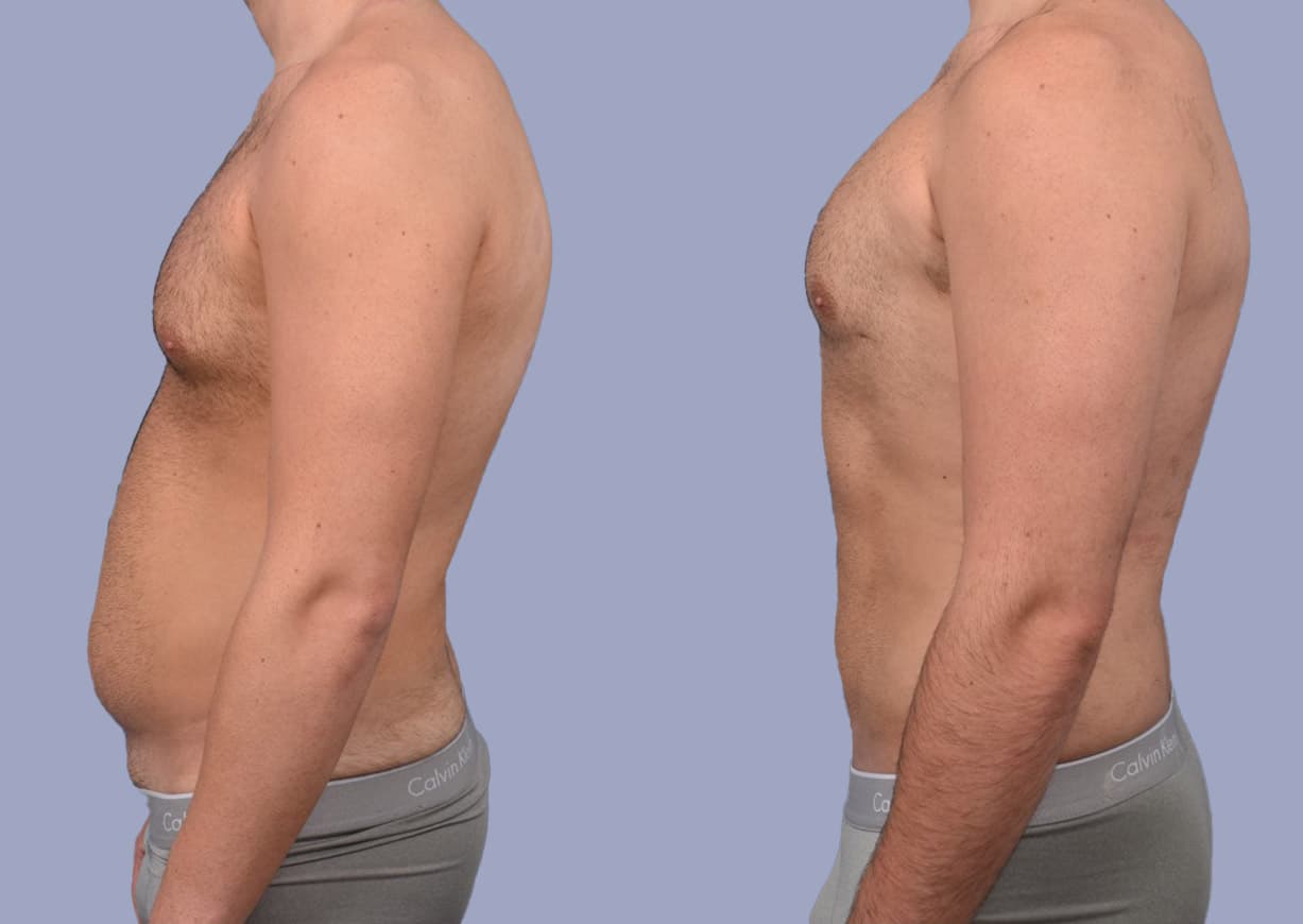 Abdominal / Flank Liposuction before and after — a patient of Dr. Stein