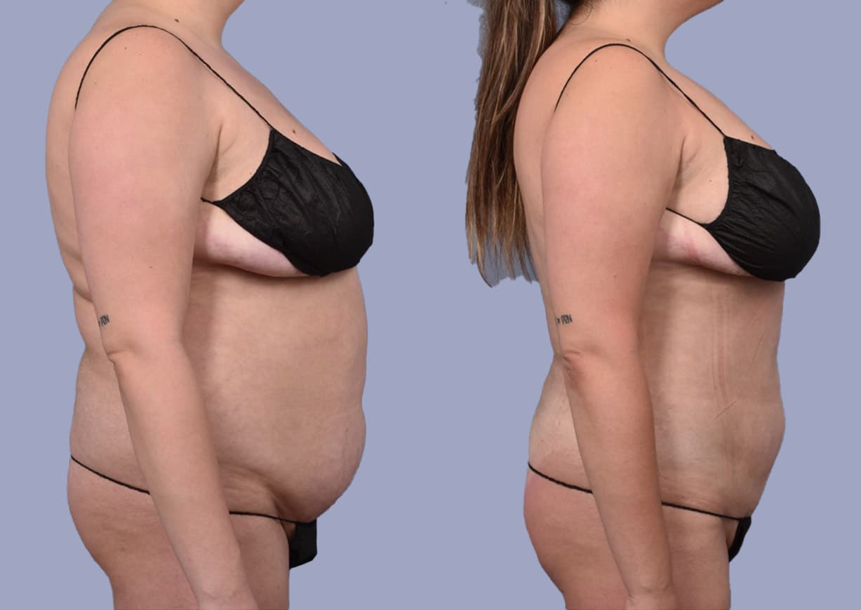 Abdominal / Flank Liposuction before and after — a patient of Dr. Stein