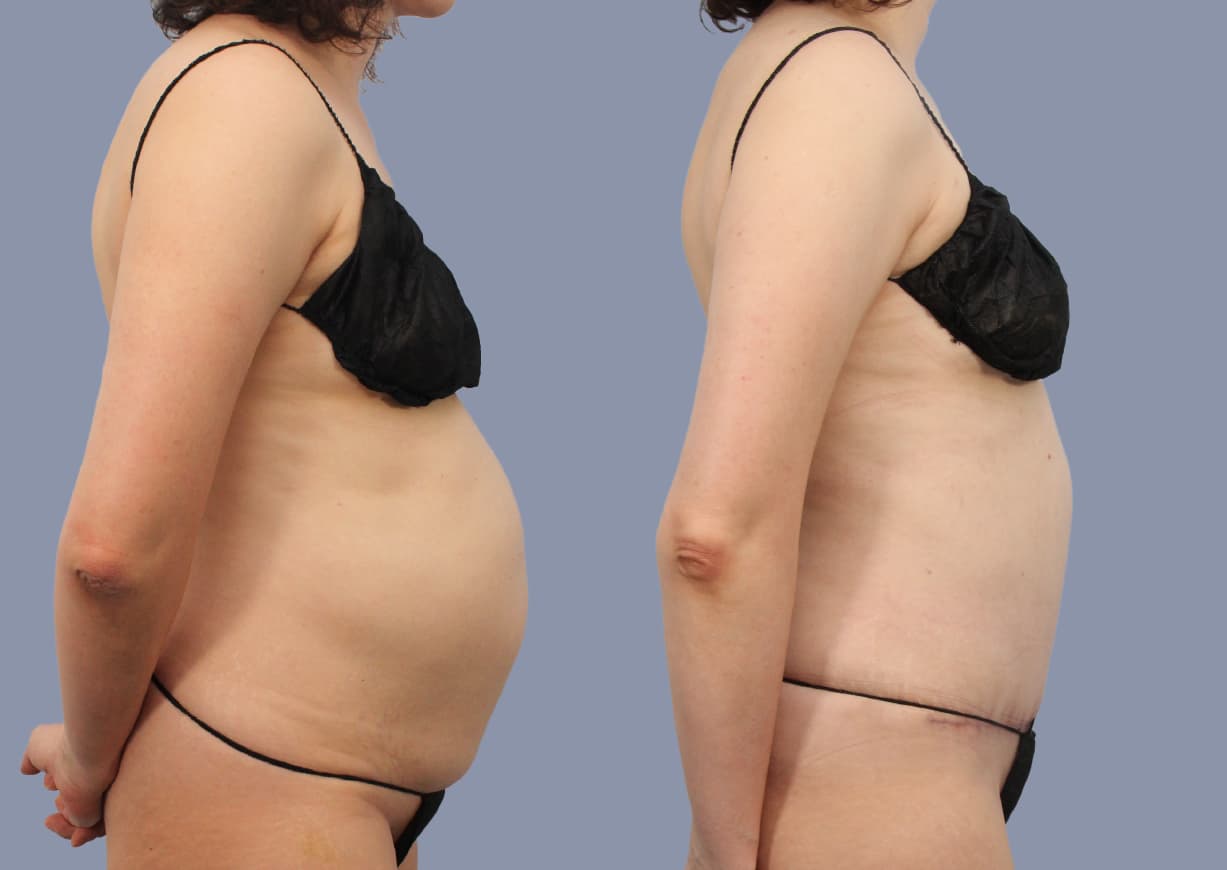 Abdominoplasty before and after, side view — a patient of Dr. Stein