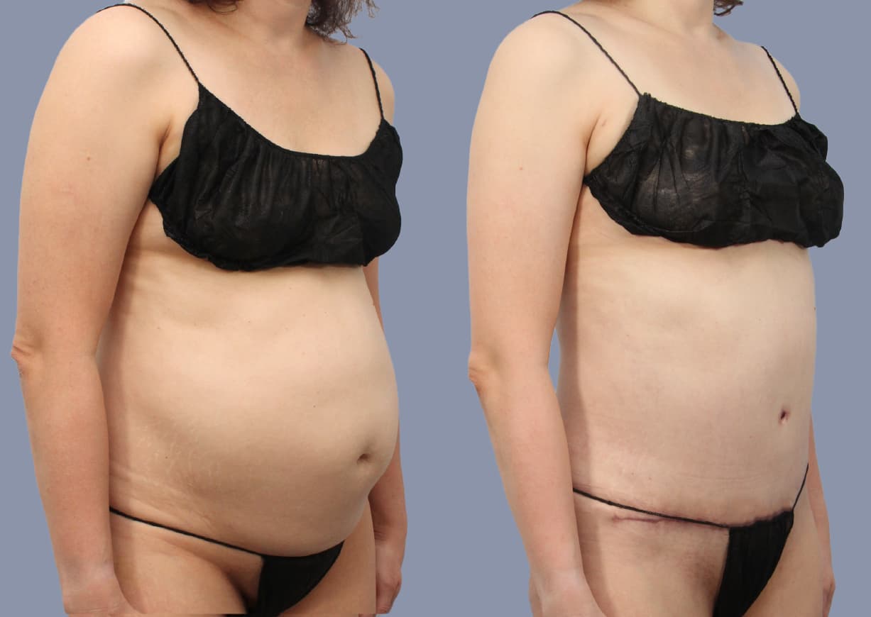 Abdominoplasty before and after, oblique view — a patient of Dr. Stein