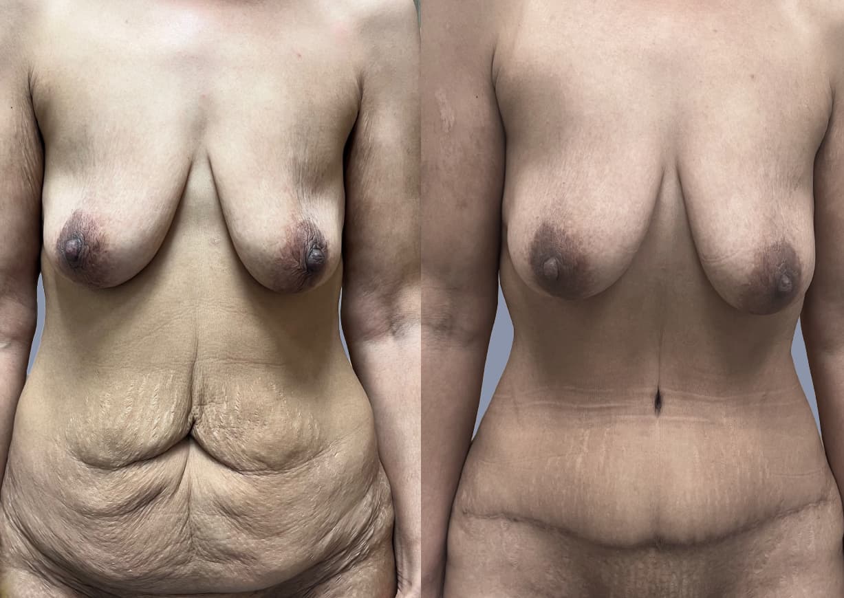Abdominoplasty before and after, front view — a patient of Dr. Stein