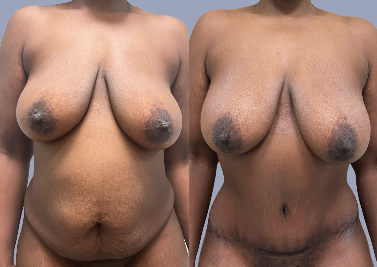 Abdominoplasty before and after, front view — a patient of Dr. Stein