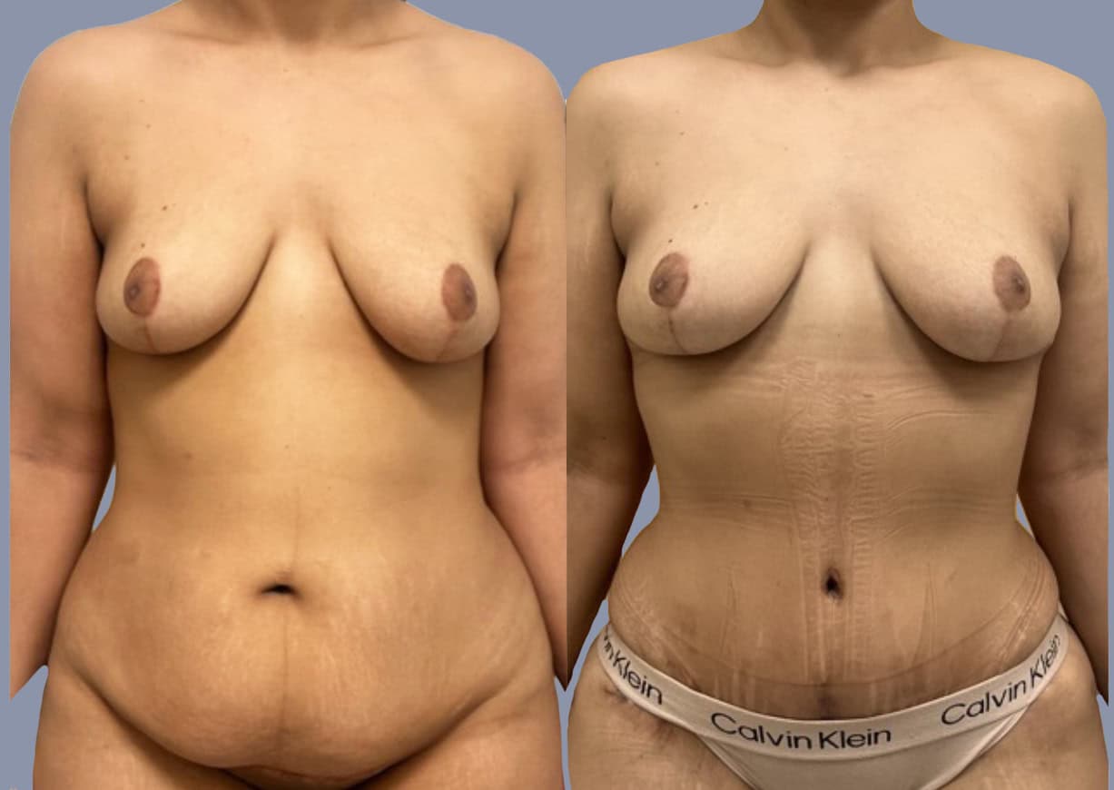Abdominoplasty before and after, front view — a patient of Dr. Stein