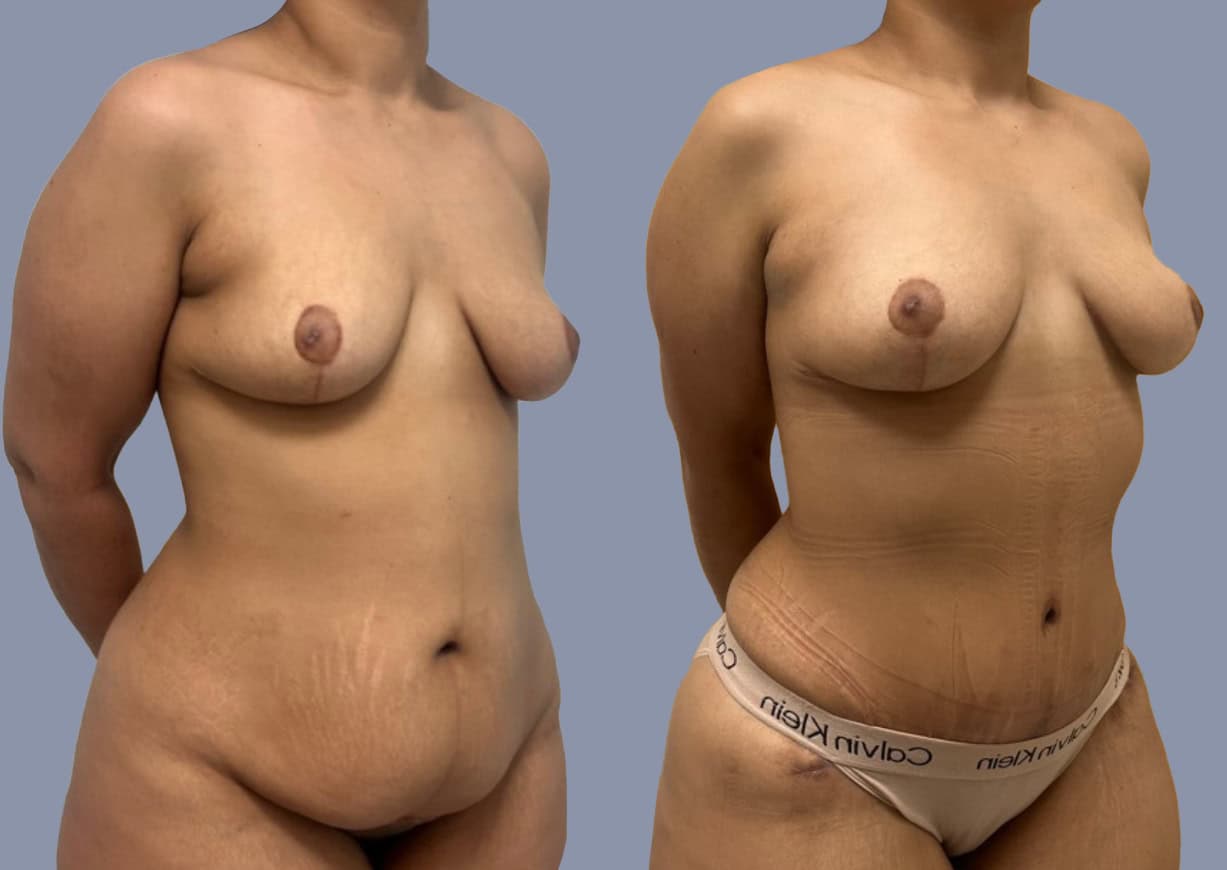 Abdominoplasty before and after, oblique view — a patient of Dr. Stein