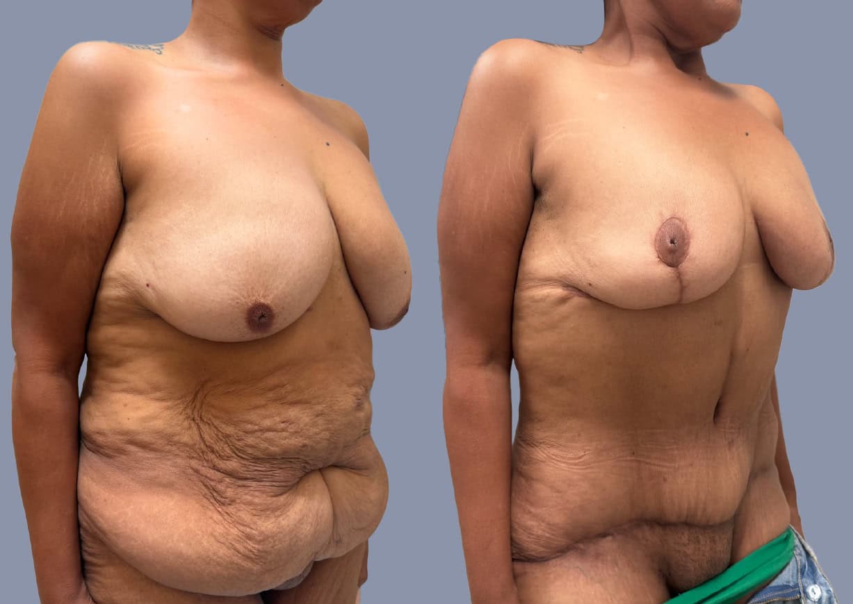 Abdominoplasty before and after, oblique view — a patient of Dr. Stein