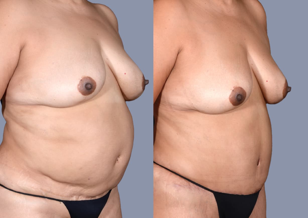 Abdominoplasty before and after, oblique view — a patient of Dr. Stein