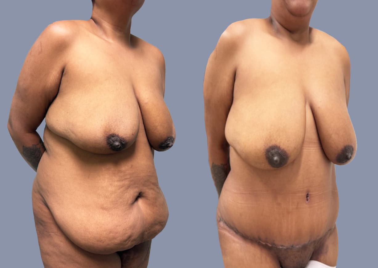 Abdominoplasty before and after, oblique view — a patient of Dr. Stein