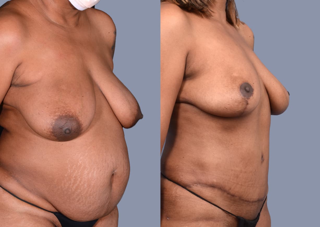Abdominoplasty before and after, oblique view — a patient of Dr. Stein