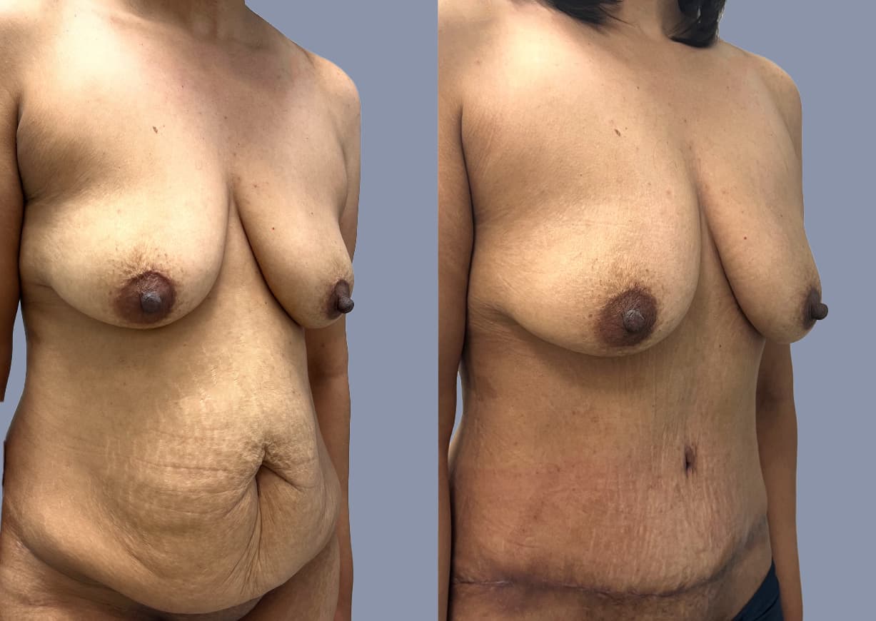 Abdominoplasty before and after, oblique view — a patient of Dr. Stein