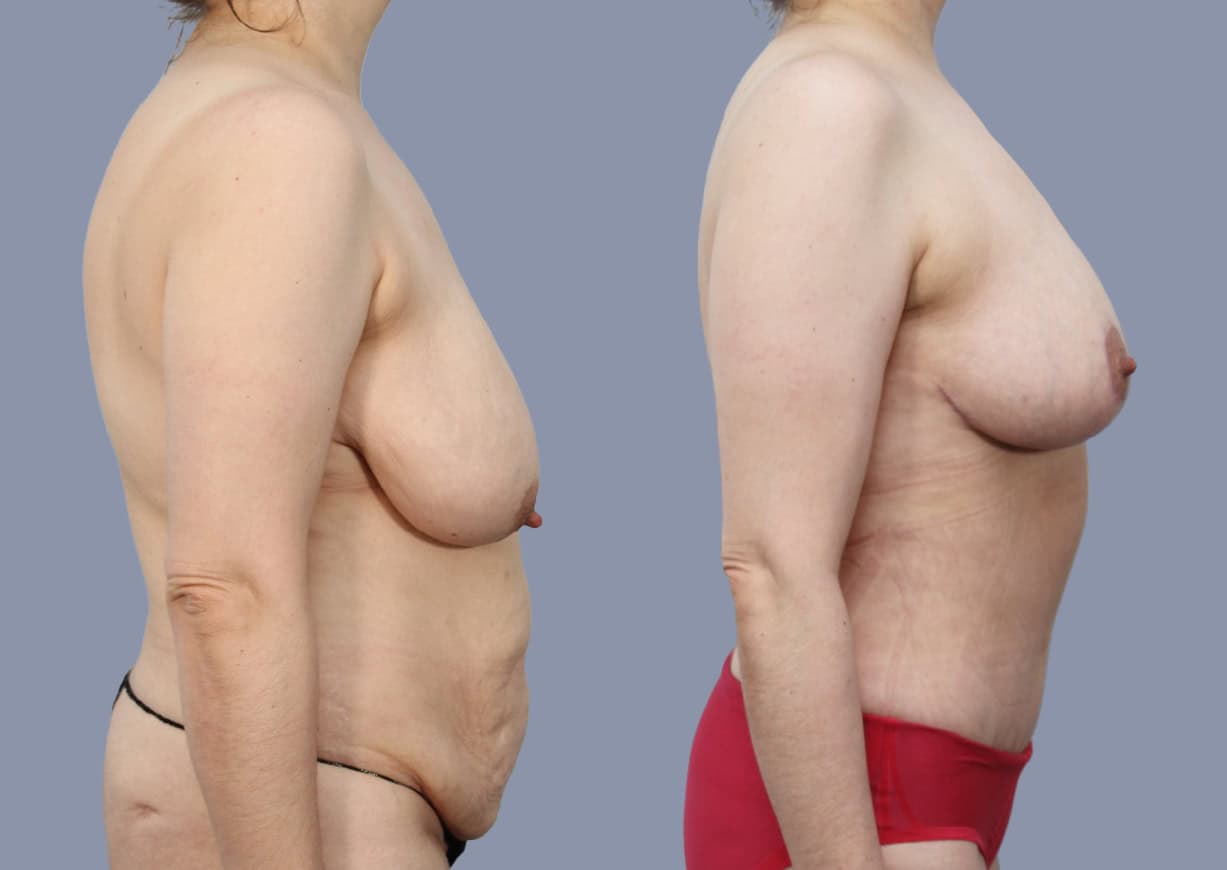 Abdominoplasty before and after, side view — a patient of Dr. Stein
