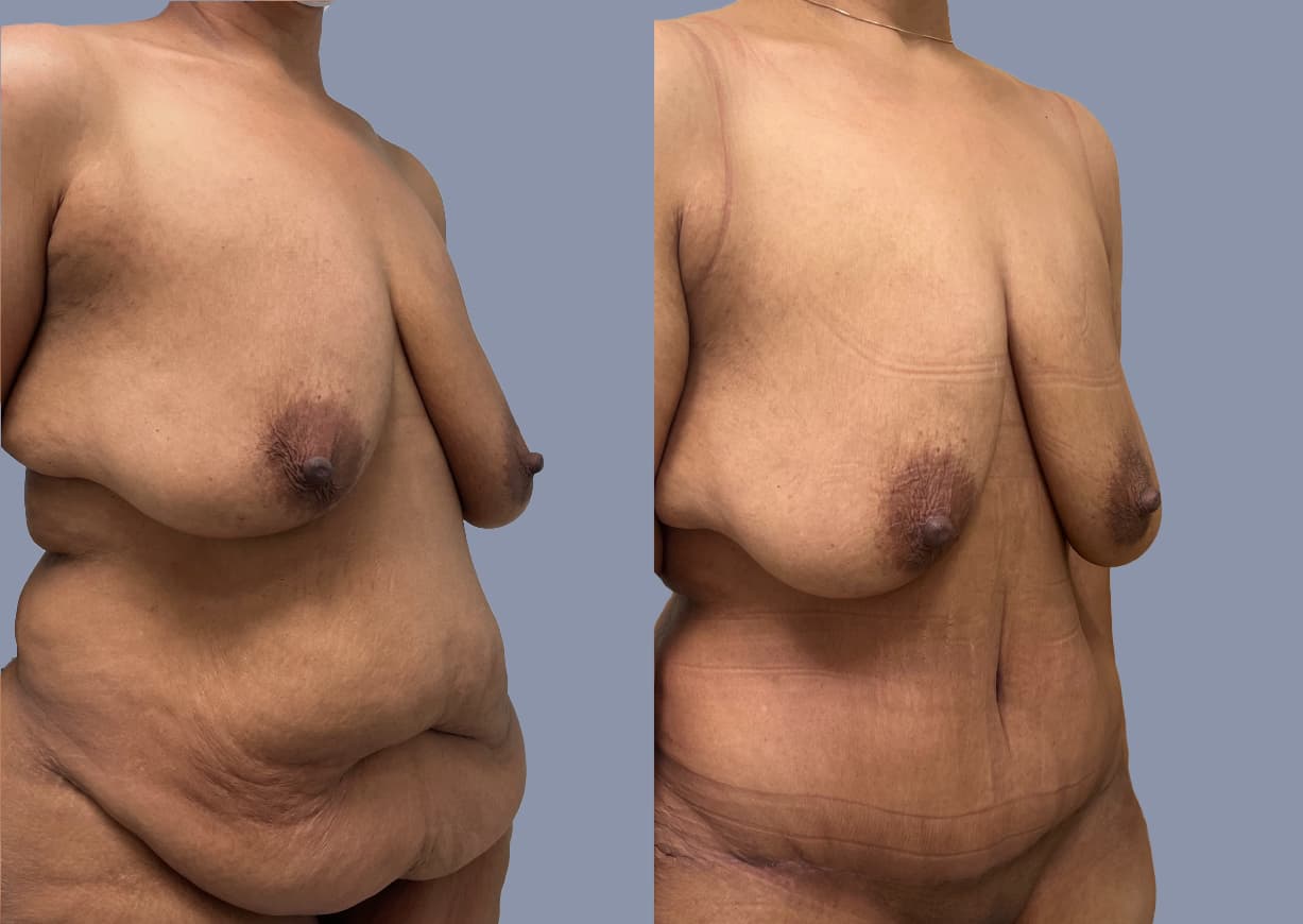 Abdominoplasty before and after, oblique view — a patient of Dr. Stein
