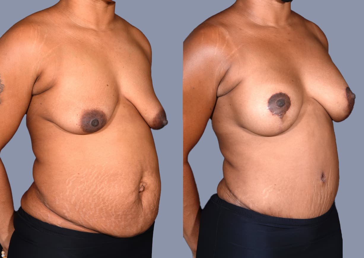 Abdominoplasty before and after, oblique view — a patient of Dr. Stein