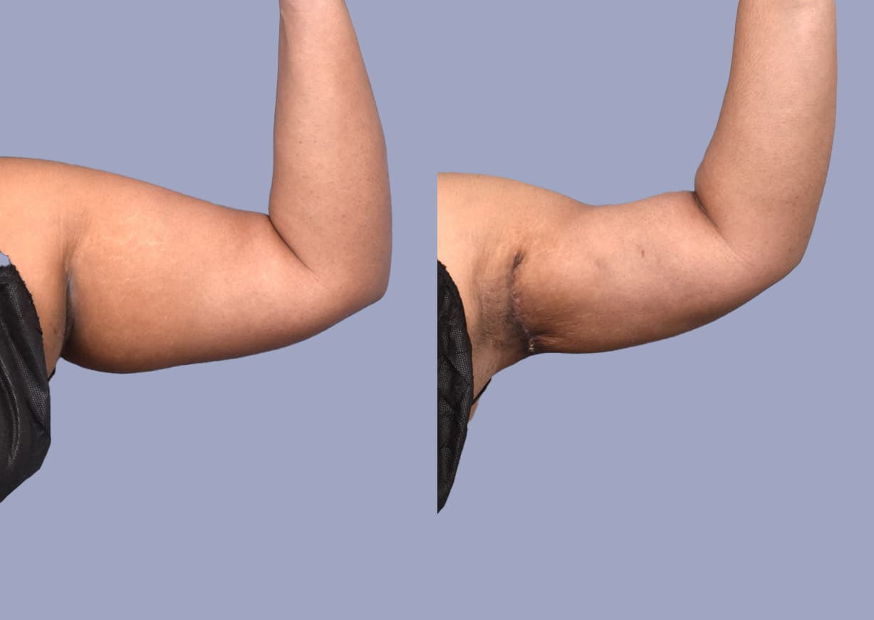 Brachioplasty before and after — a patient of Dr. Stein