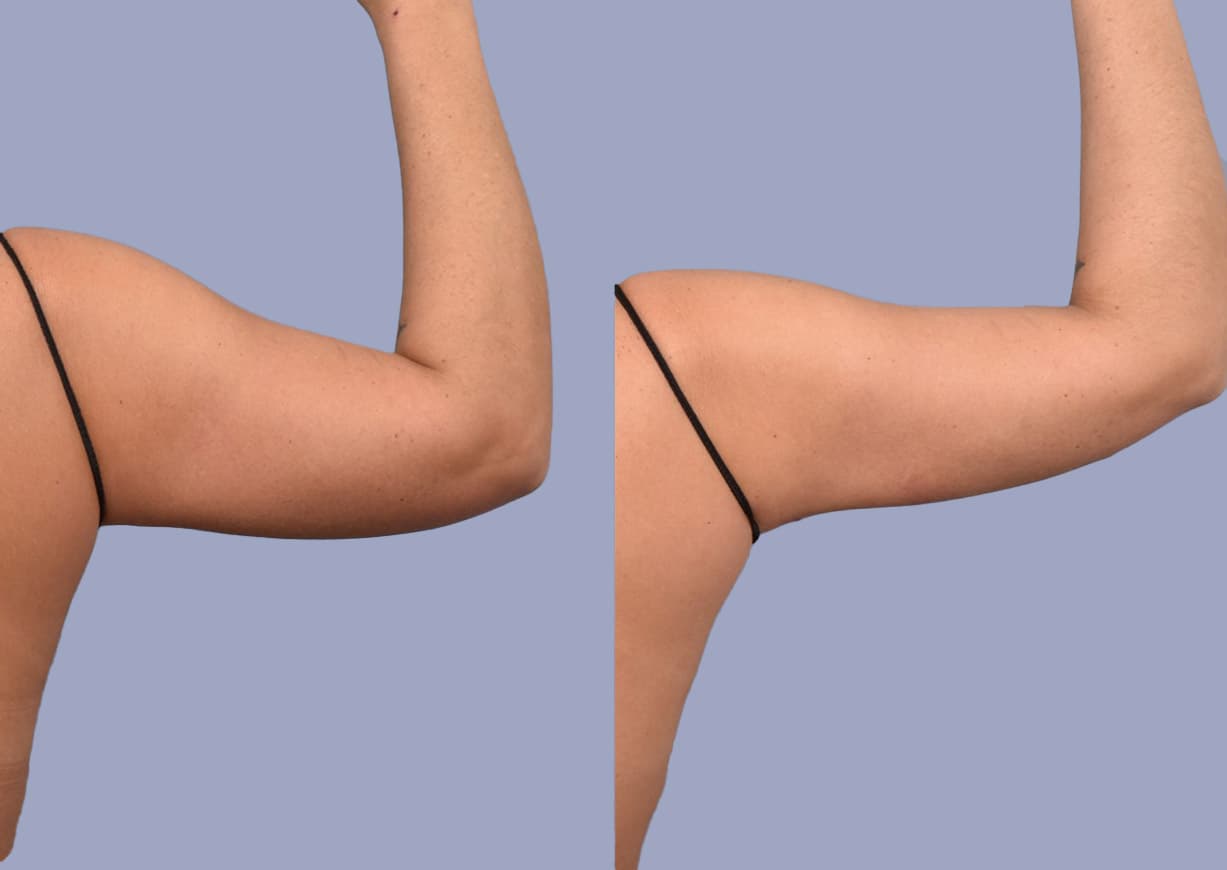 Brachioplasty before and after — a patient of Dr. Stein