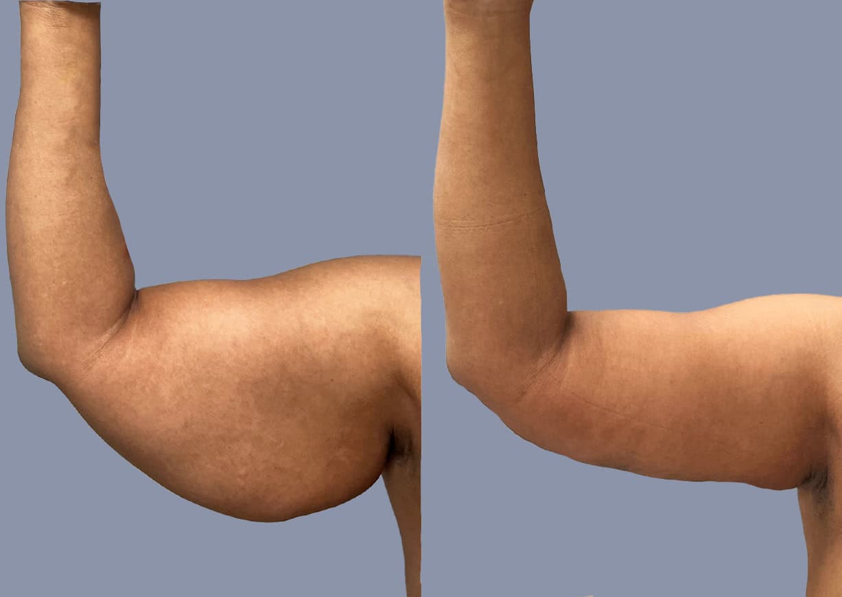 Brachioplasty before and after — a patient of Dr. Stein