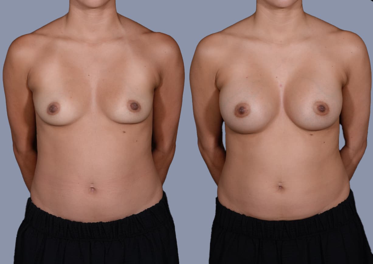Breast Augmentation before and after, front view — a patient of Dr. Stein
