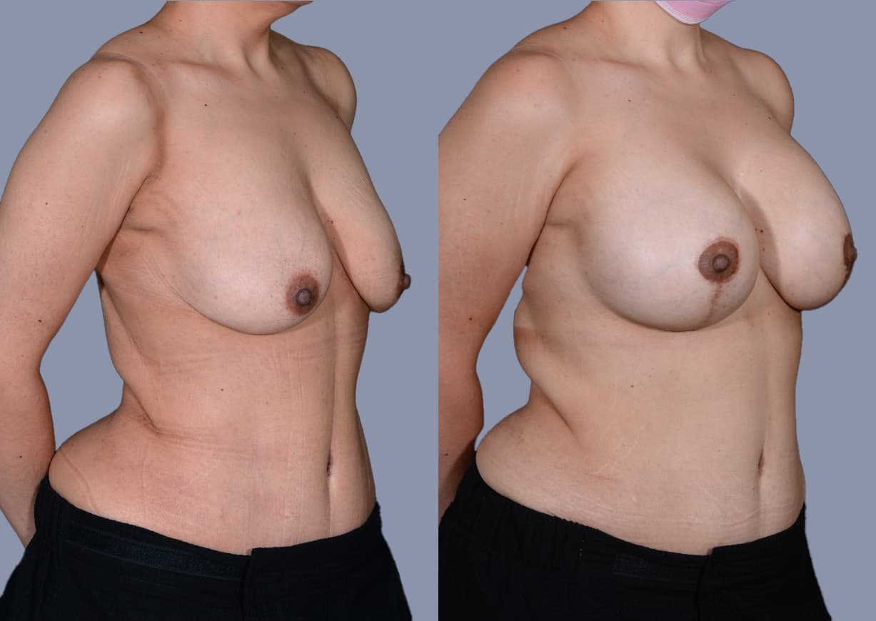 Breast Augmentation before and after, oblique view — a patient of Dr. Stein