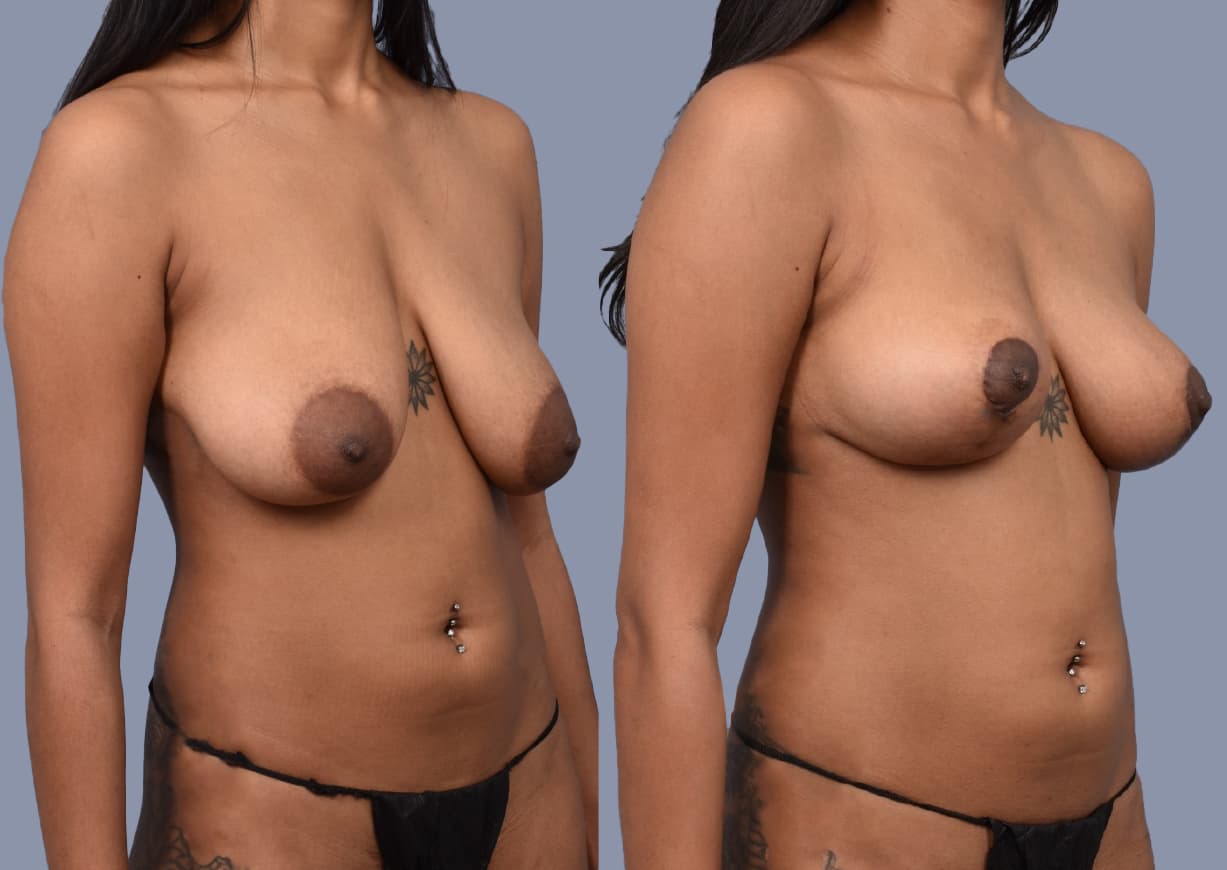 Breast Lift before and after, oblique view — a patient of Dr. Stein