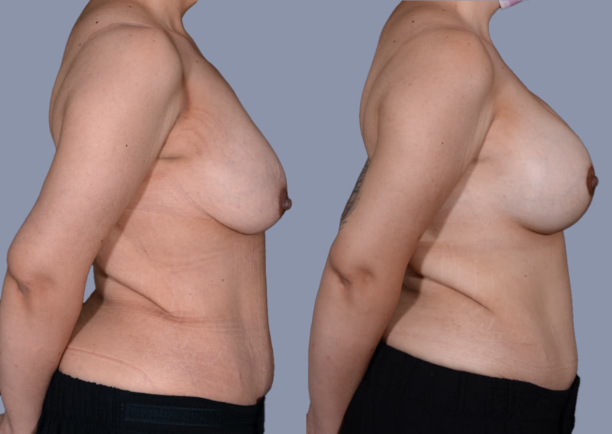 Breast Lift before and after, side view — a patient of Dr. Stein