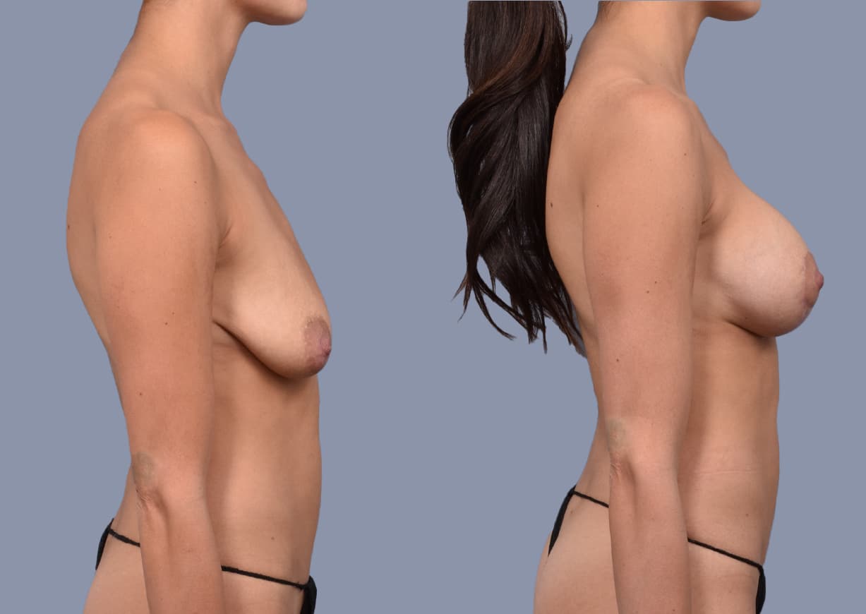 Breast Lift before and after, side view — a patient of Dr. Stein
