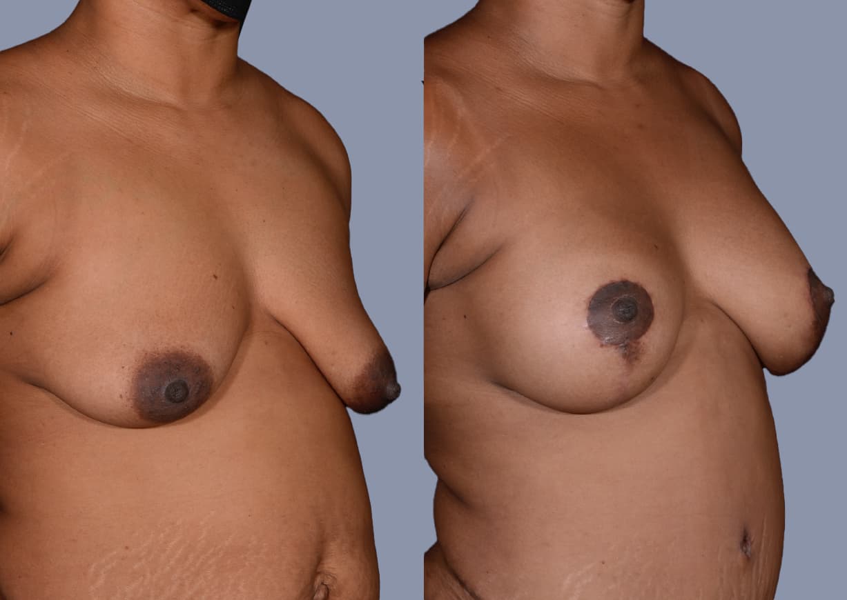 Breast Lift before and after, oblique view — a patient of Dr. Stein