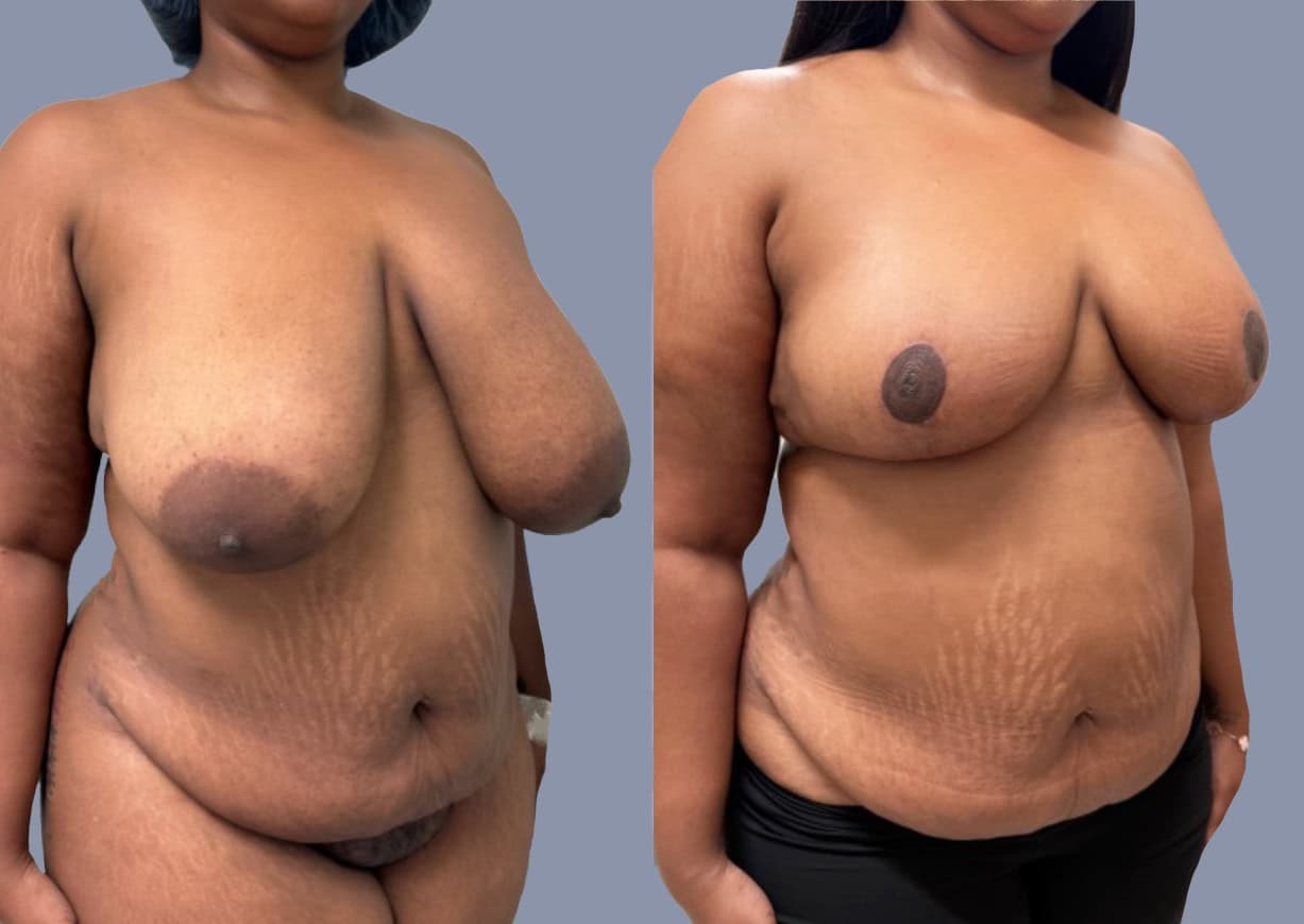 Breast Reduction before and after, oblique view — a patient of Dr. Stein