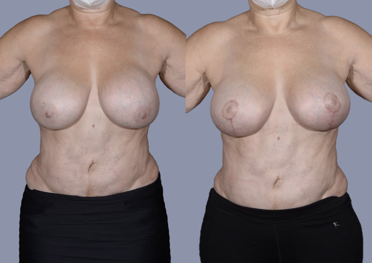 Breast Revision before and after — a patient of Dr. Stein