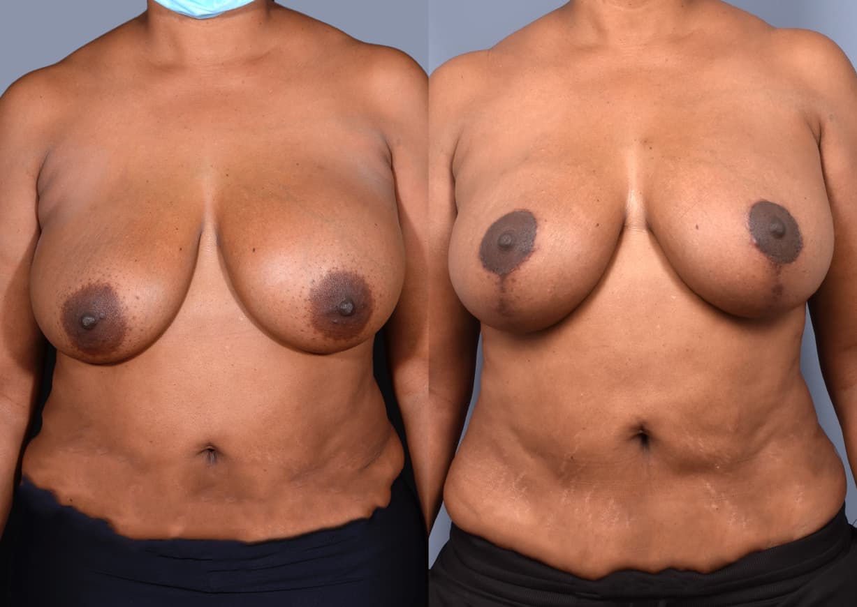Breast Revision before and after, front view — a patient of Dr. Stein