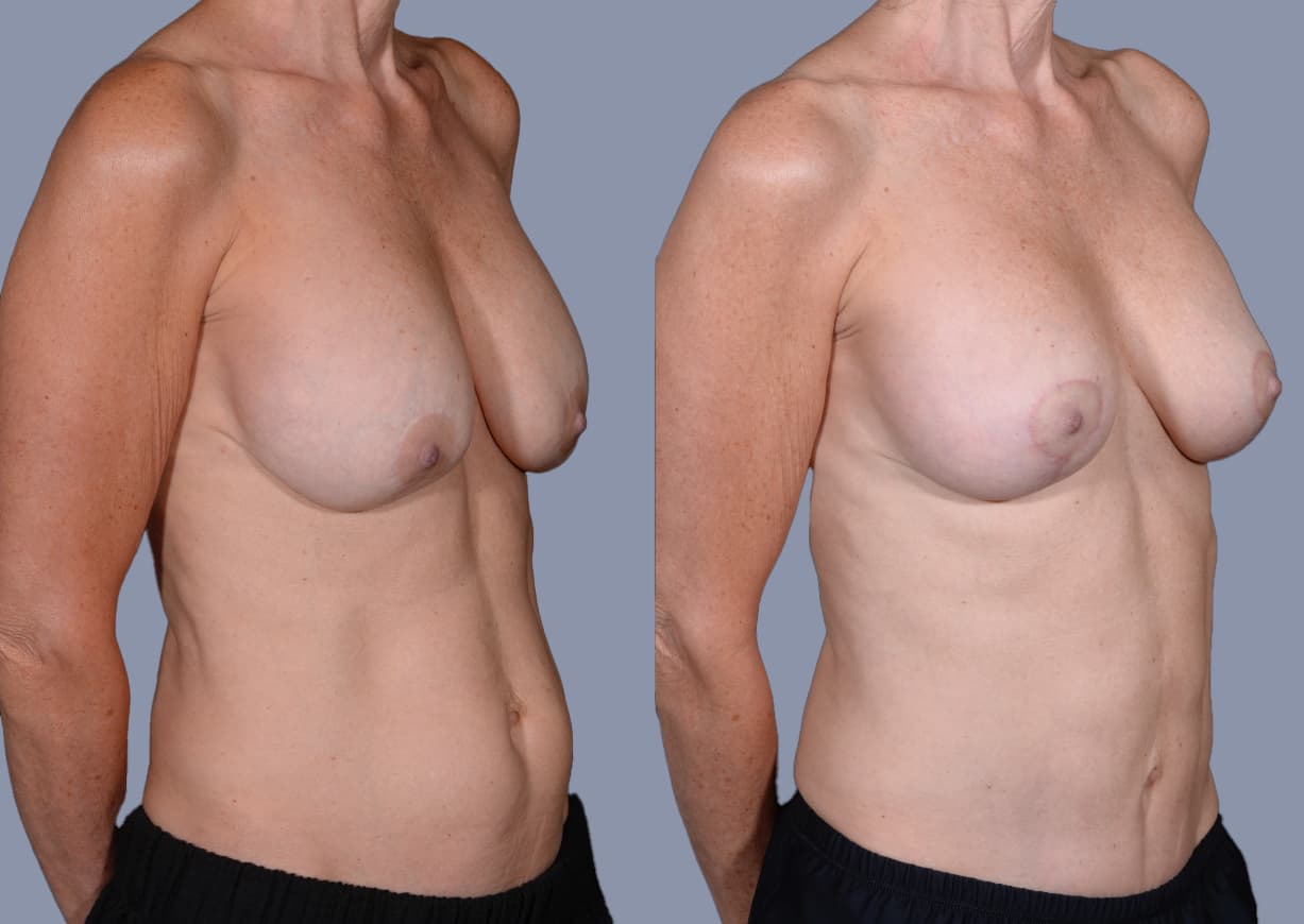 Breast Revision before and after, oblique view — a patient of Dr. Stein