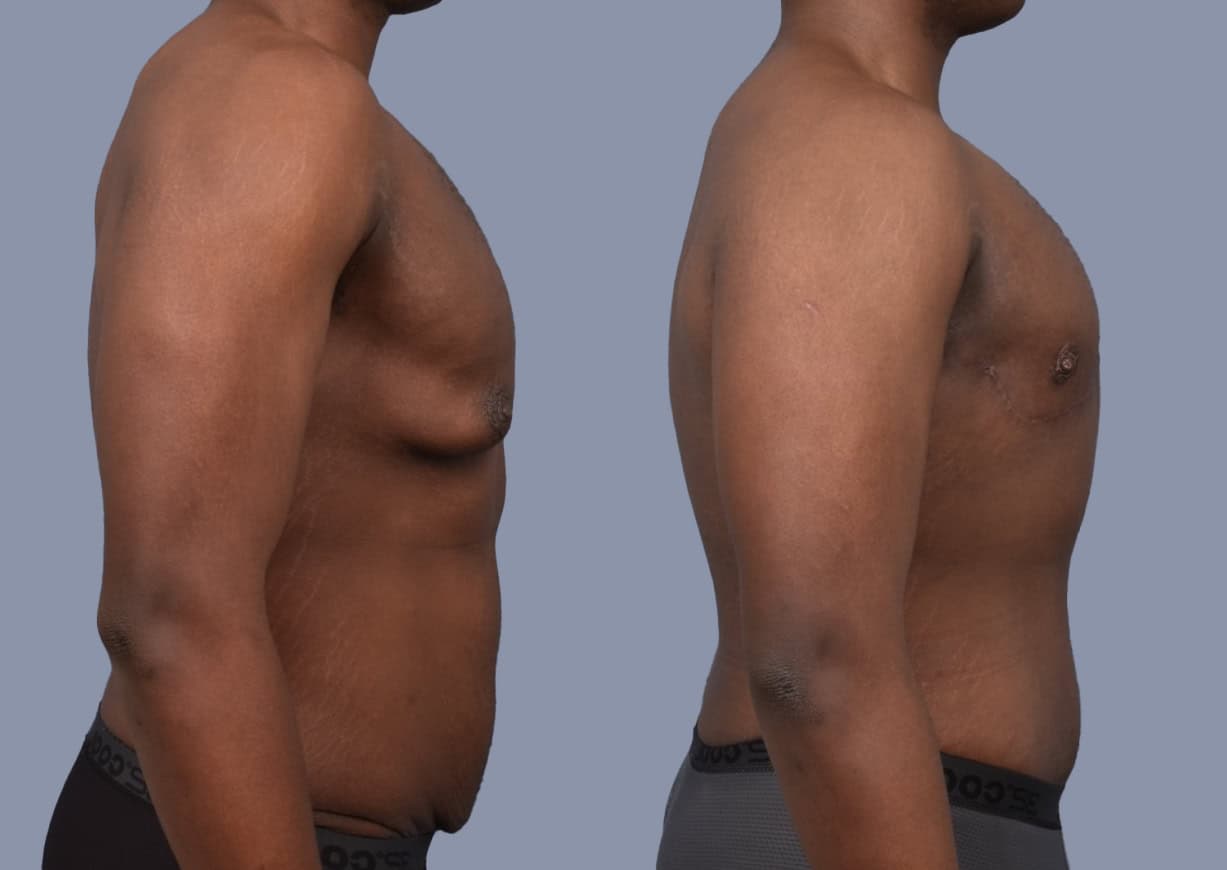 Gynecomastia before and after, side view — a patient of Dr. Stein