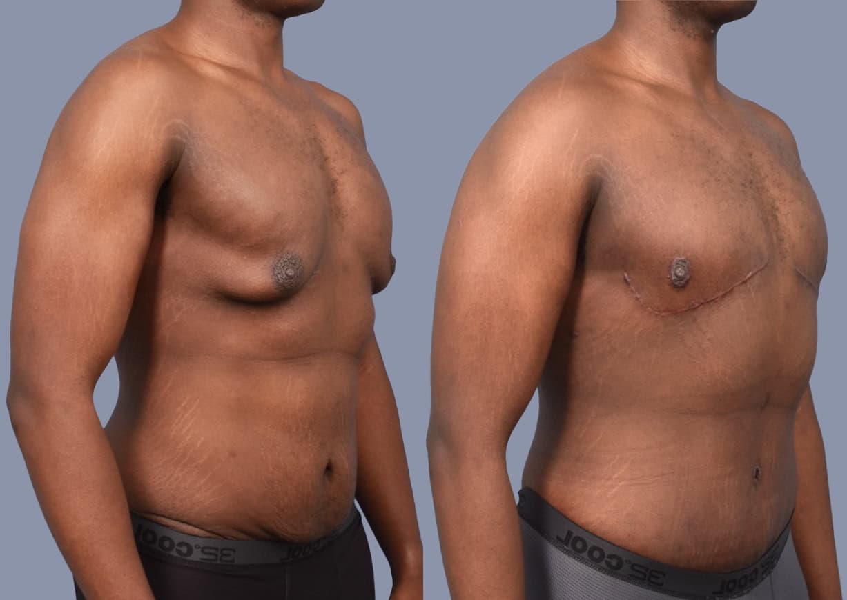 Gynecomastia before and after, oblique view — a patient of Dr. Stein