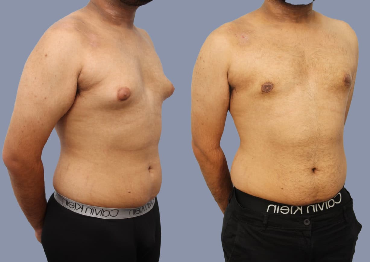 Gynecomastia before and after, oblique view — a patient of Dr. Stein
