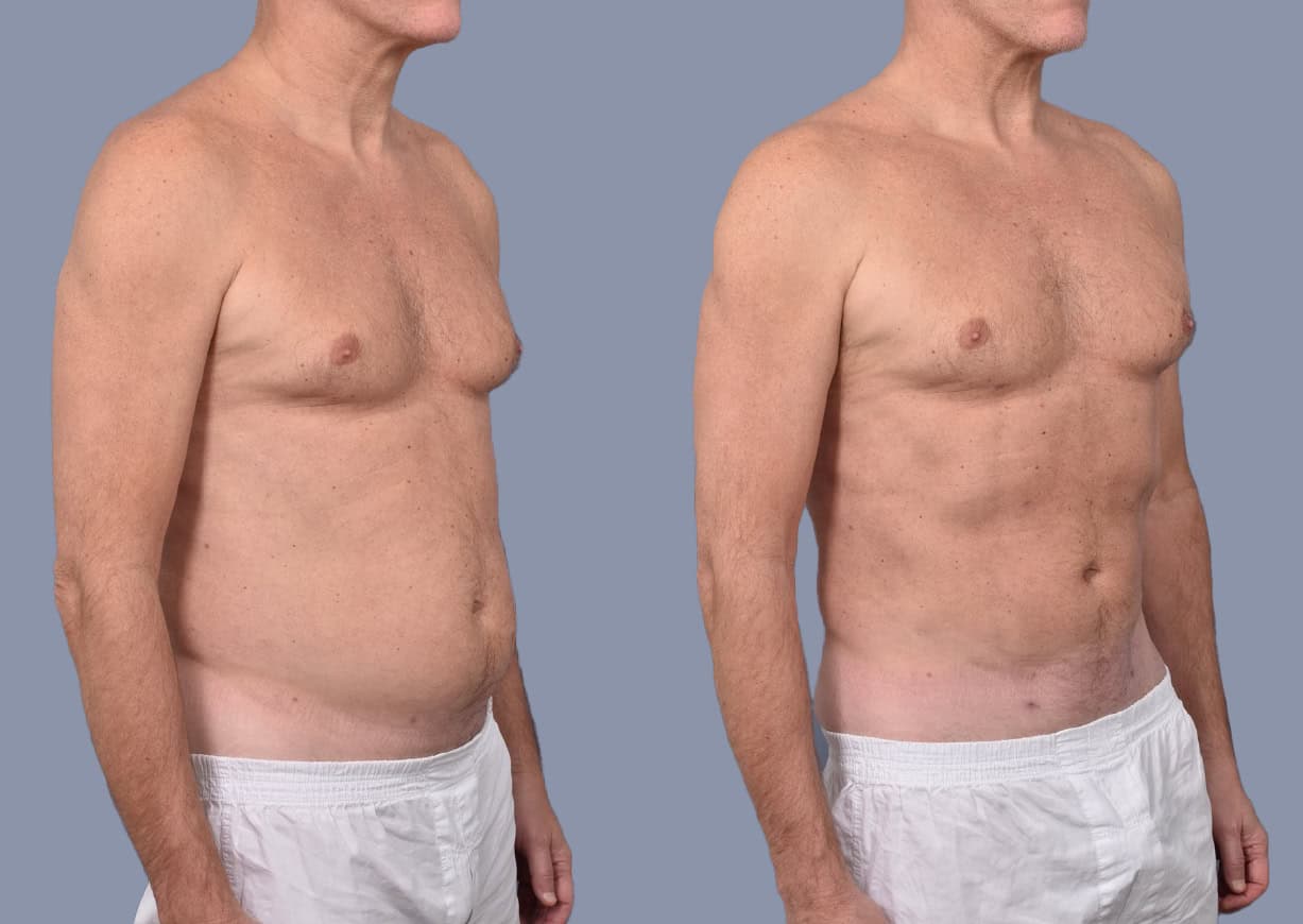 High-Definition Liposuction before and after, oblique view — a patient of Dr. Stein