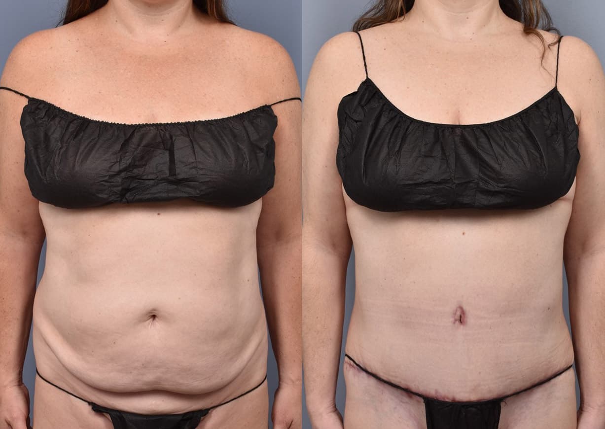 Mommy Makeover before and after — a patient of Dr. Stein