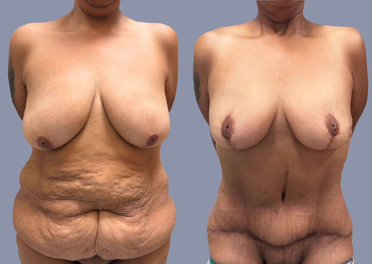 Mommy Makeover before and after, front view — a patient of Dr. Stein