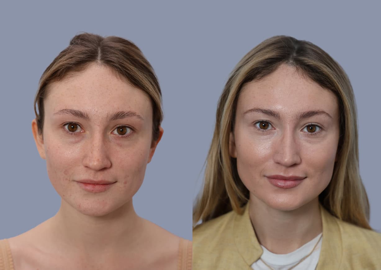 Neck Liposuction before and after, front view — a patient of Dr. Stein