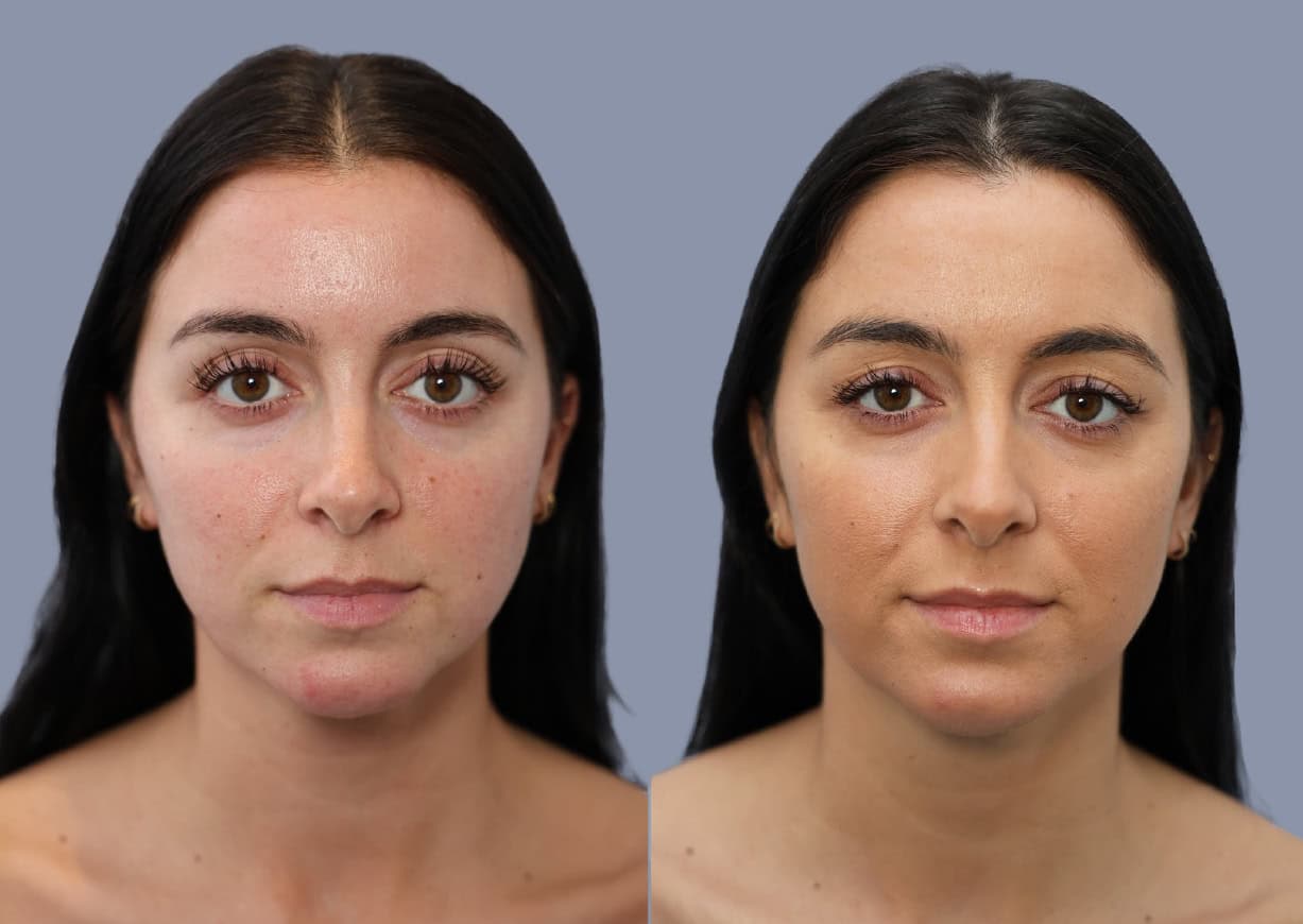 Neck Liposuction before and after, front view — a patient of Dr. Stein