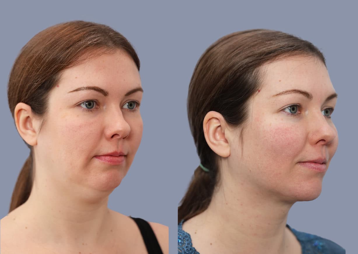 Neck Liposuction before and after, oblique view — a patient of Dr. Stein