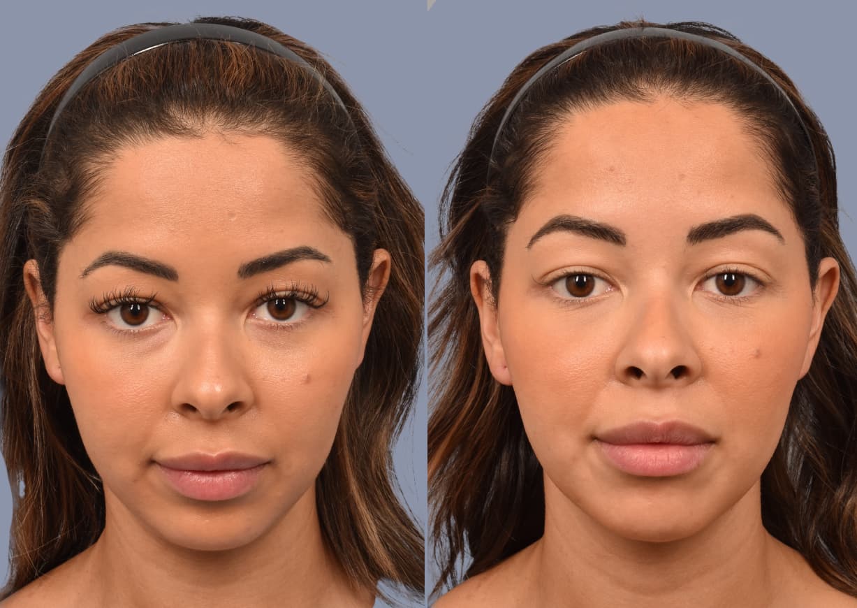 Neck Liposuction before and after, front view — a patient of Dr. Stein
