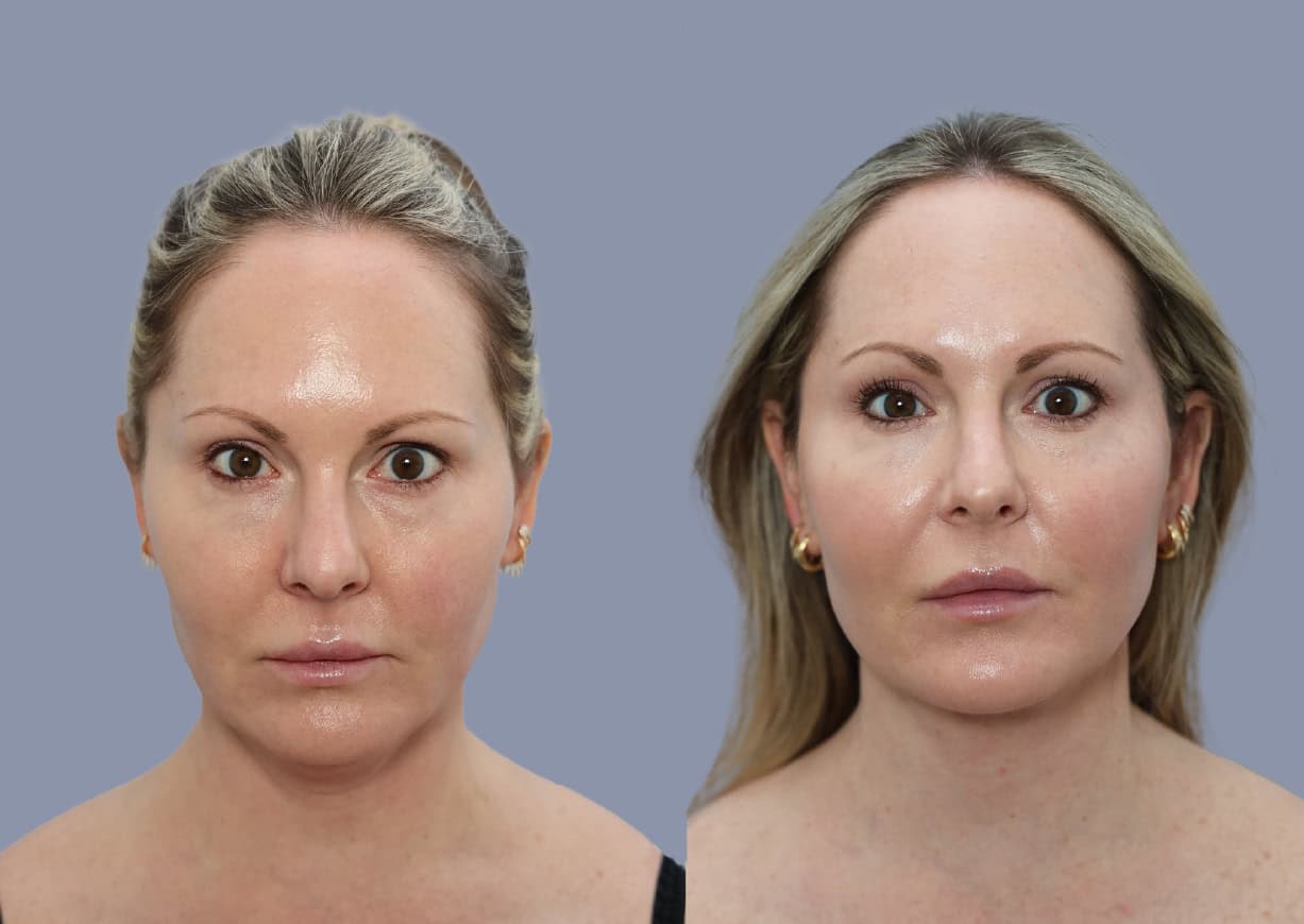Neck Liposuction before and after, front view — a patient of Dr. Stein