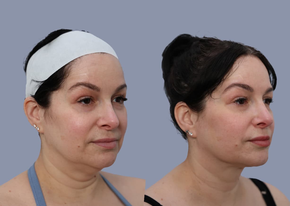 Neck Liposuction before and after, oblique view — a patient of Dr. Stein