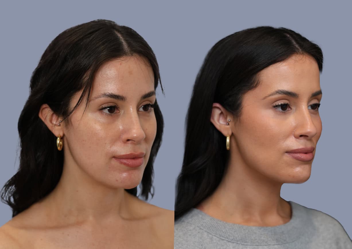 Neck Liposuction before and after, oblique view — a patient of Dr. Stein