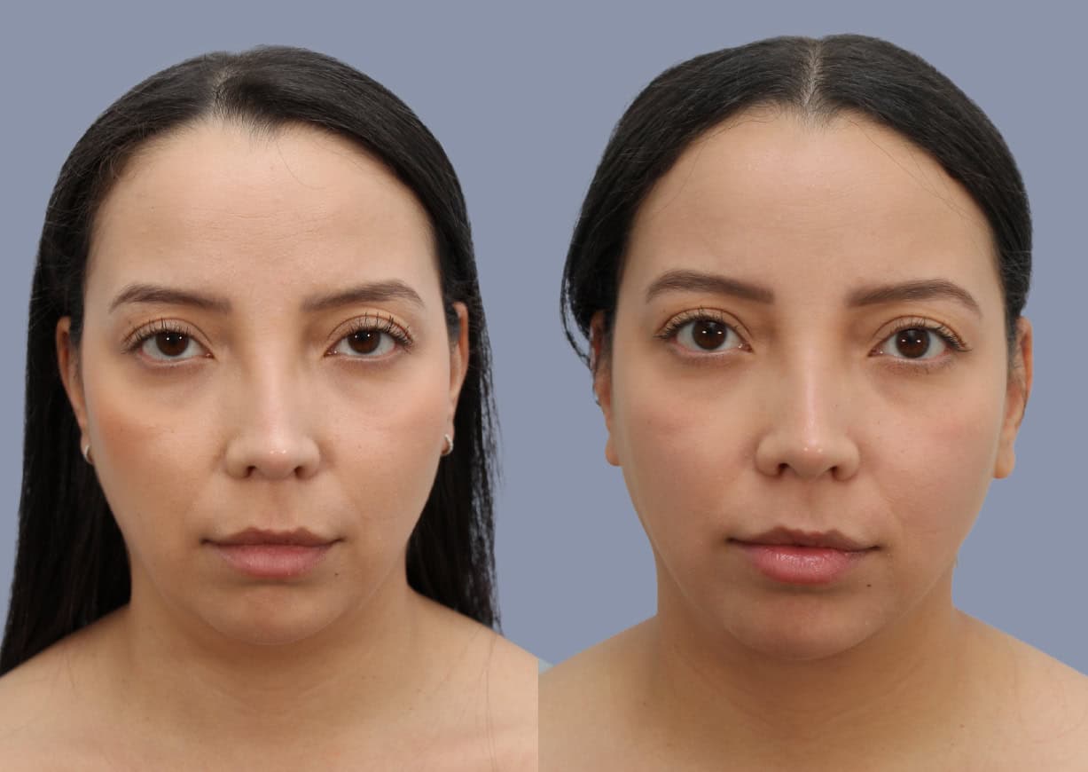 Neck Liposuction before and after, front view — a patient of Dr. Stein