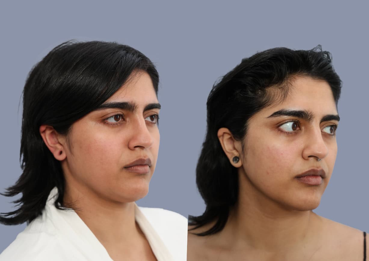 Neck Liposuction before and after, oblique view — a patient of Dr. Stein