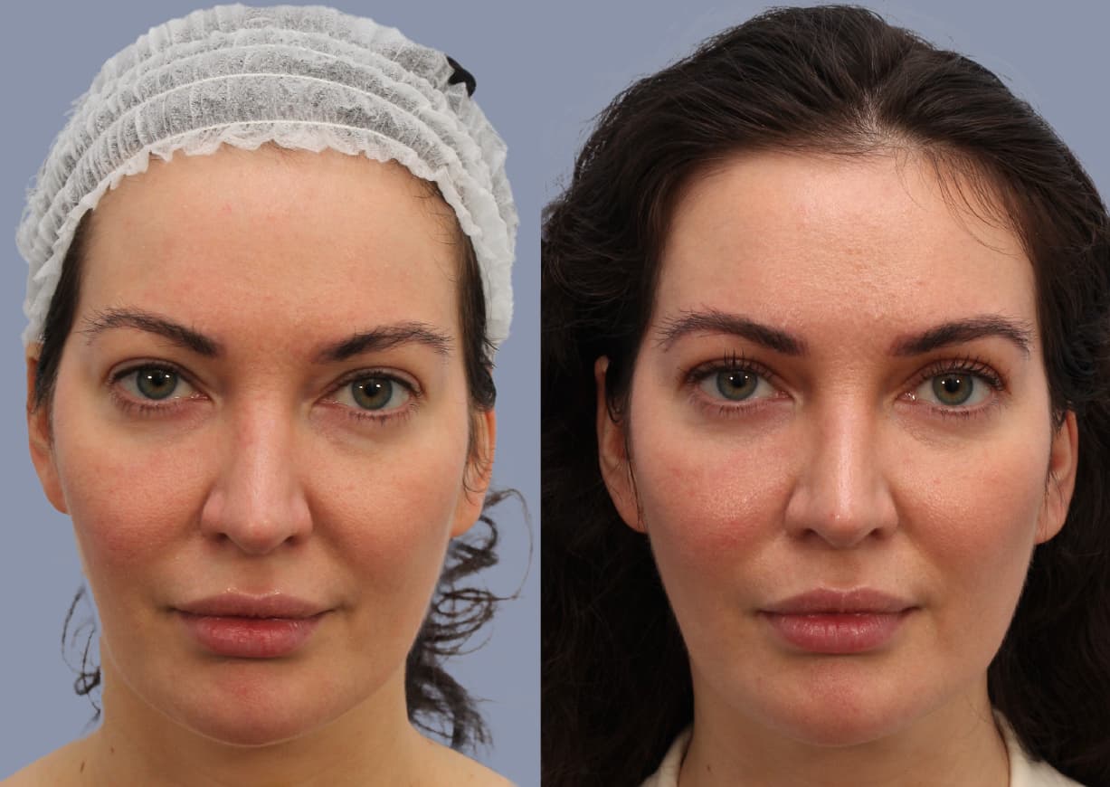 Neck Liposuction before and after, front view — a patient of Dr. Stein